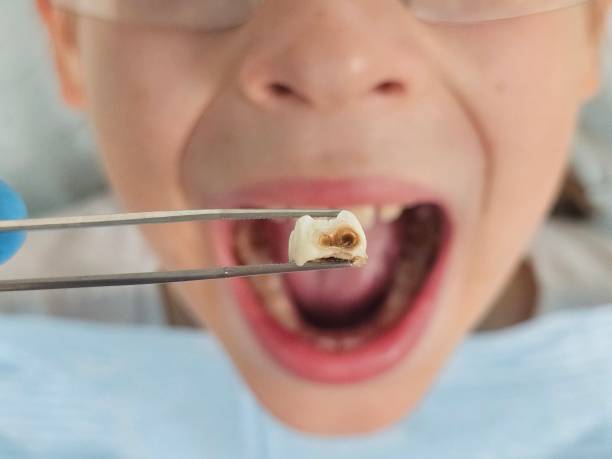 Best Chipped Tooth Repair Near Me  in Combes, TX